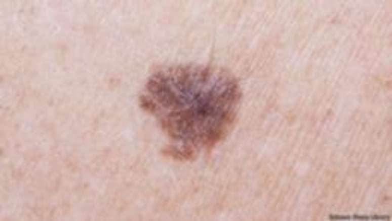 Excesso de pintas pode ser sinal de uma propensão ao câncer de pele