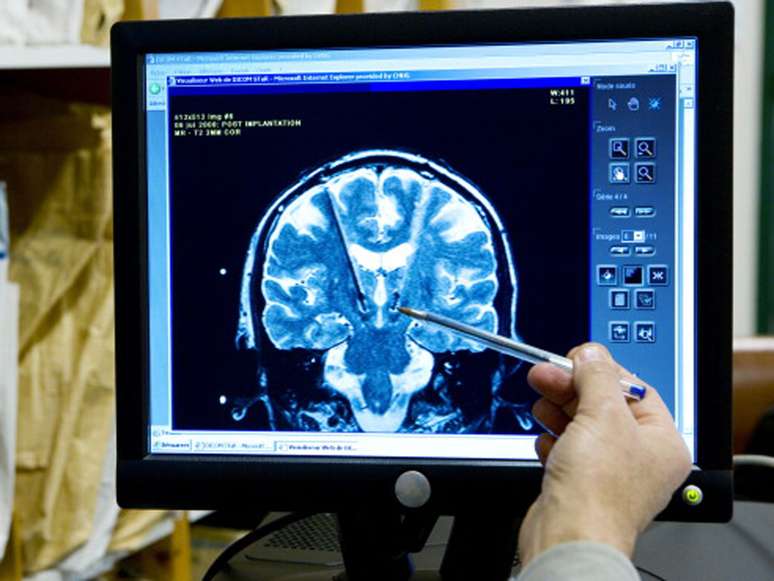 Con el paciente consciente, los neurólogos podrán saber dónde colocar los electrodos y hacer las pruebas necesarias.