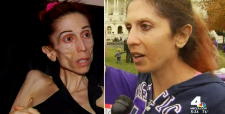 Em pricesso de recupera&ccedil;&atilde;o, Rachael apareceu irreconhec&iacute;vel na Marcha Anual Contra Transtornos Alimentares