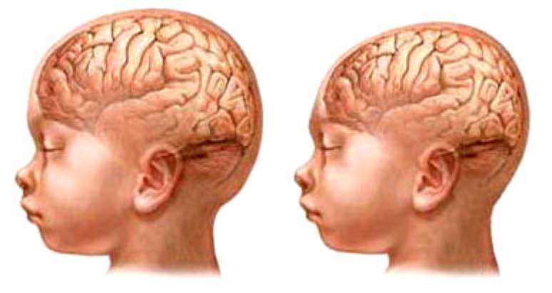 Ilustração da esquerda mostra criança com tamanha normal de cabeça. À direita, criança com microcefalia
