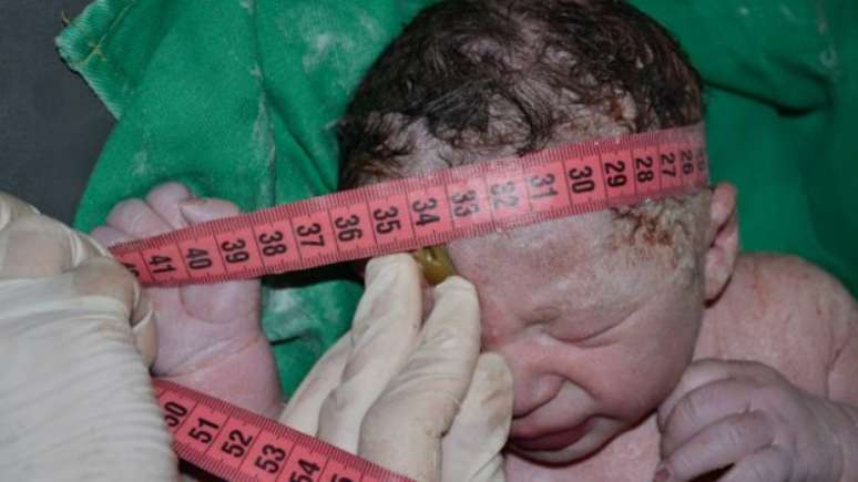 Além do perímetro cefálico ao nascer, médicos avaliam ritmo de crescimento da cabeça do bebê para confirmar ou descartar microcefalia