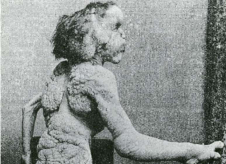 Joseph Merrick foi chamado de Homem Elefante no s&eacute;culo 19