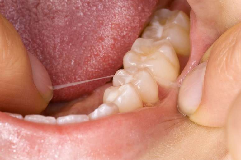 O dente do siso é o último a se formar, por volta dos nove anos de idade, e por isso nasce mais tarde, entre os 17 e 20 anos