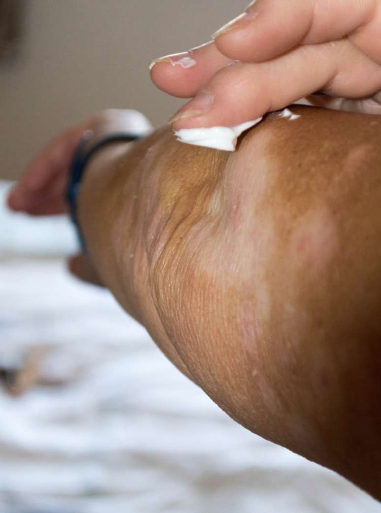 Pano branco causa manchas.