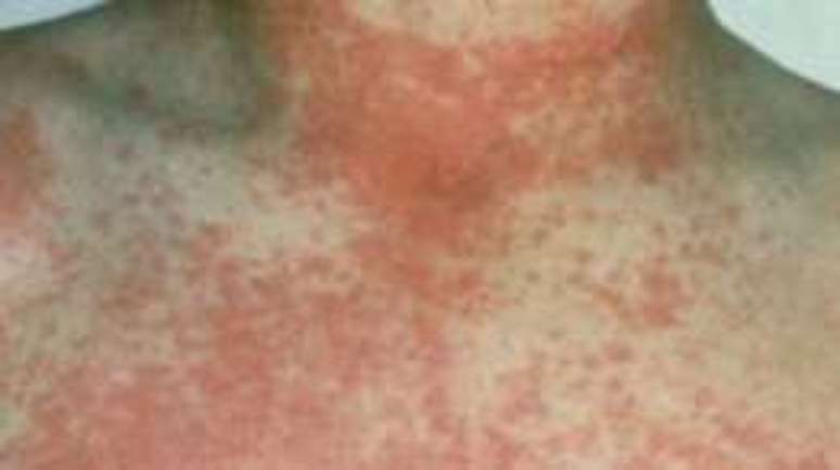 Vermelhidão e textura áspera da pele podem se espalhar por várias partes do corpo