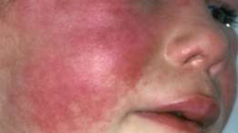 Sintomas da doença incluem textura áspera da pele e vermelhidão, além de dor de garganta