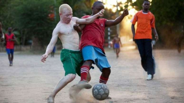 Na Tanzânia, albinos são perseguidos devido a crenças locais