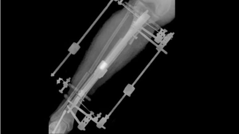 O dispositivo fixador externo permite um crescimento da tíbia de um milímetro por dia