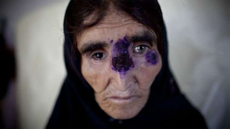 Leishmaniose deixa feridas e pode deformar permanentemente; acima, mulher recebe tratamento em Cabul, no Afeganistão, em 2010