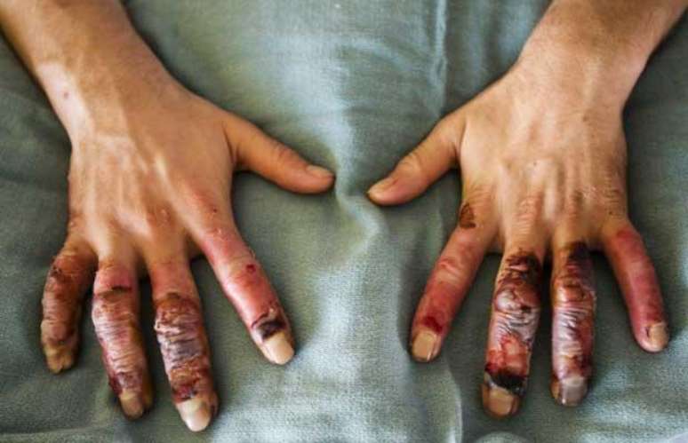 Queimaduras de frio (frostbite) nos dedos de um paciente