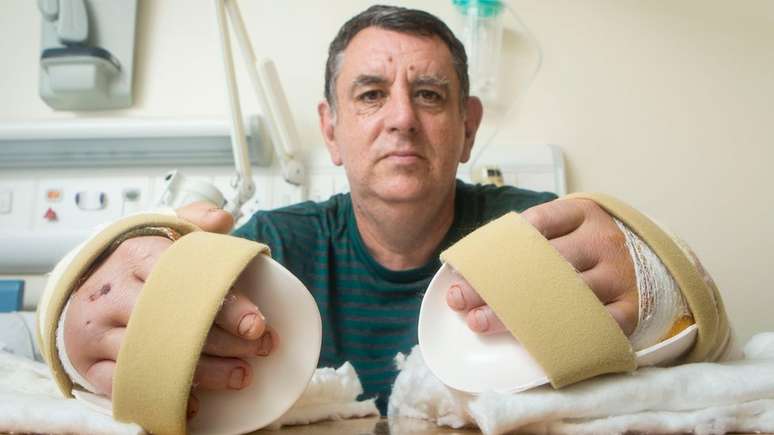 Em 22 de julho passado, Chris King recebeu o primeiro transplante duplo de mãos realizado no Reino Unido