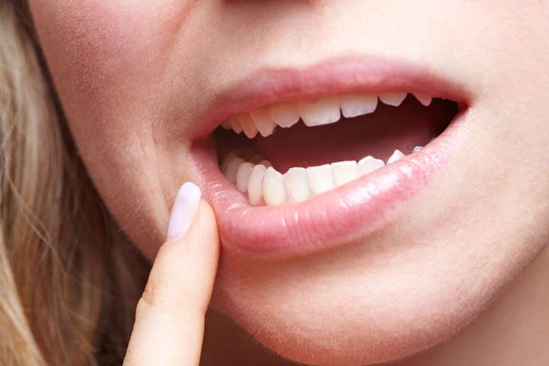 “Estudos feitos com pessoas que extraíram e não extraíram esses dentes mostram que certos apinhamentos ocorreriam do mesmo jeito”, diz Érick Santos Duarte, cirurgião-dentista bucomaxilofacial. 