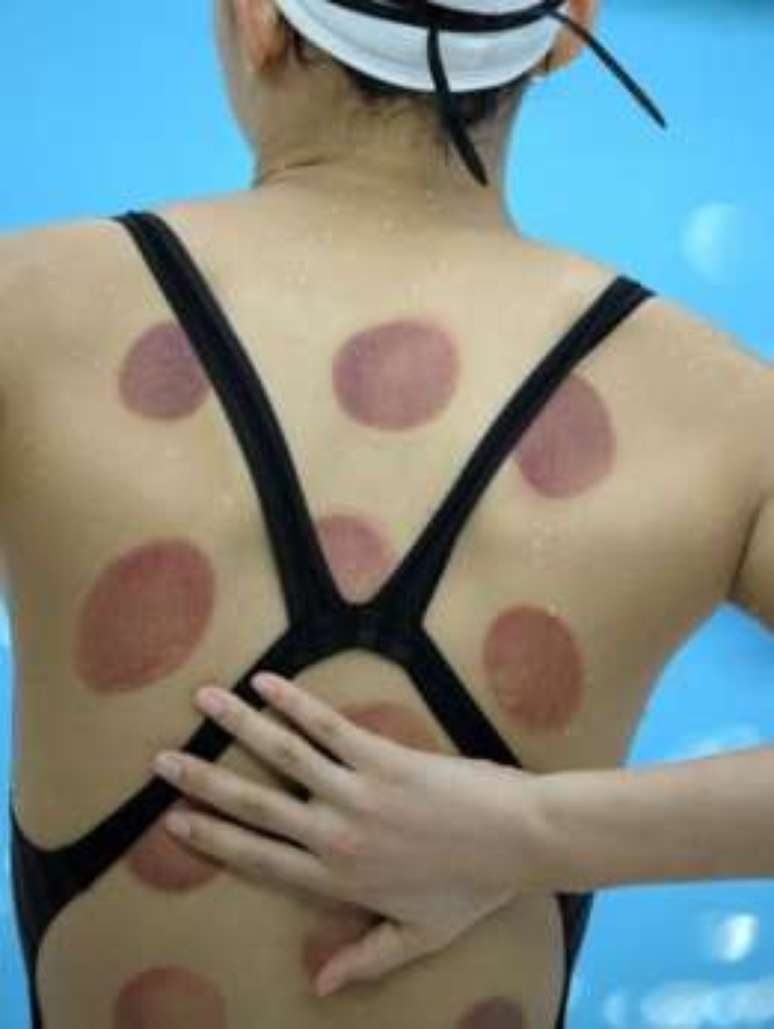 A nadadora chinesa Wang Qun fez o tratamento antes de competir nos Jogos Ol&iacute;mpicos de Pequim 2008