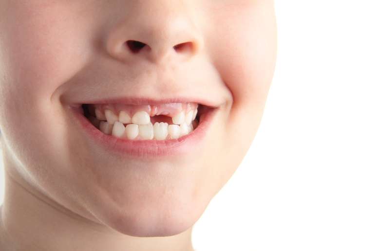 O permanente também demora para dar as caras quando o dente de leite cai muito cedo por causa de uma cárie ou um trauma