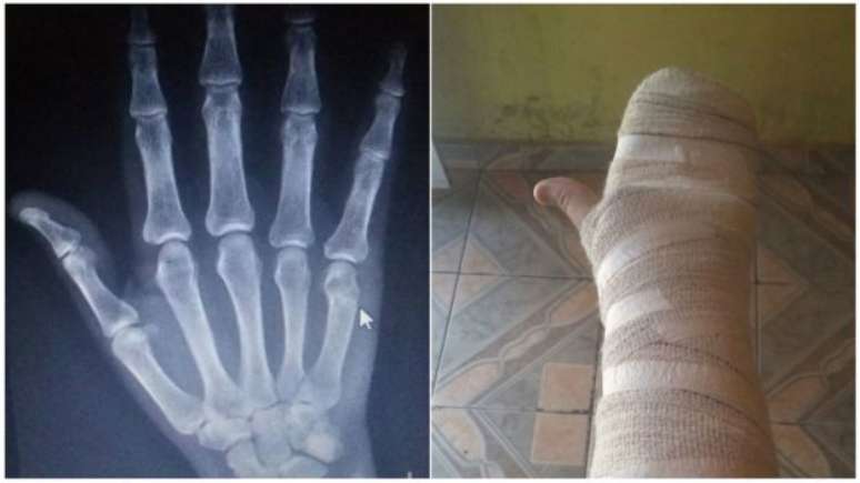 Raio-X e m&atilde;o enfaixada de motorista do Uber ferido ap&oacute;s reagir a assalto na capital paulista