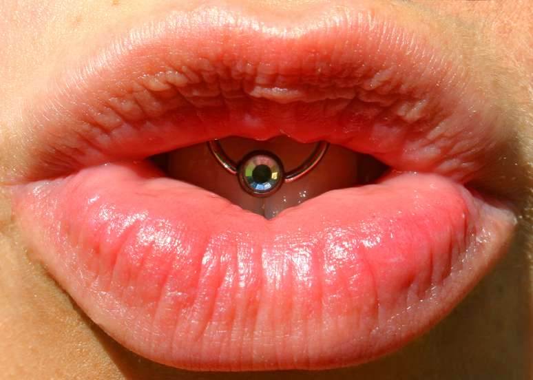 Cada local apresenta um risco potencial diferente, os de língua causam mais fraturas dos dentes, enquanto os de lábio, mais retração gengival pelo atrito com a gengiva
