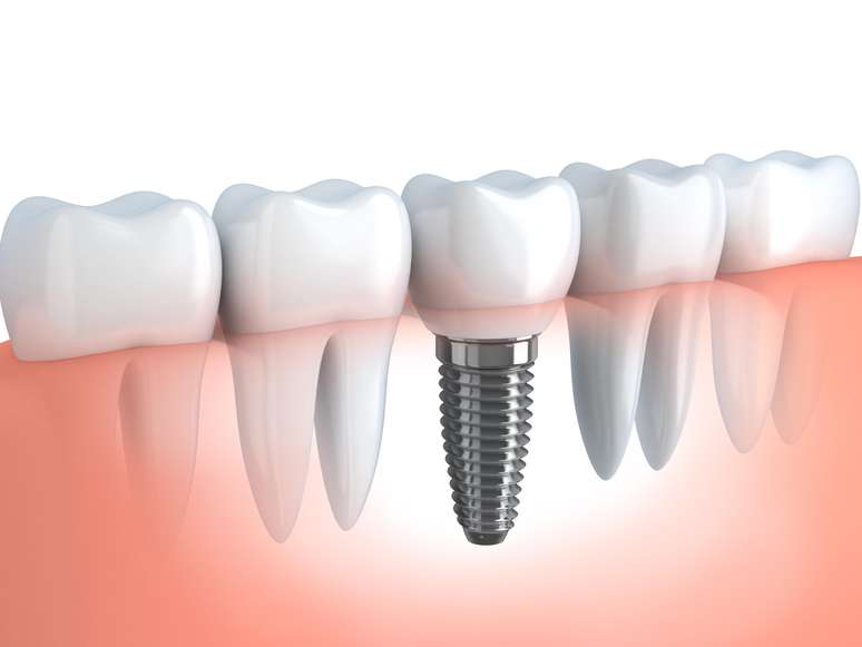 Um tratamento com implantes não deverá ser iniciado até que os pacientes saibam realizar uma boa higienização bucal 