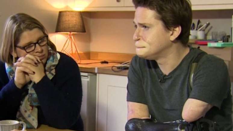 Alex Lewis perdeu todos os membros por causa de uma infec&ccedil;&atilde;o 