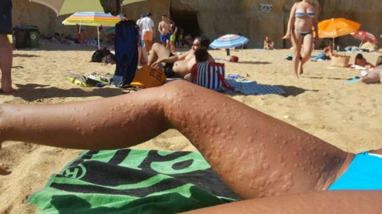 No verão, a brisa fresca da praia foi suficiente para encher de urticária o corpo de Beatriz Sánchez 