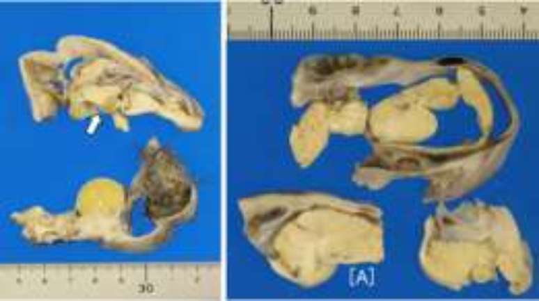 Imagens do tumor, que tinha pelos e uma estrutura em forma de cérebro de 3cm coberta por uma placa de osso craniano.