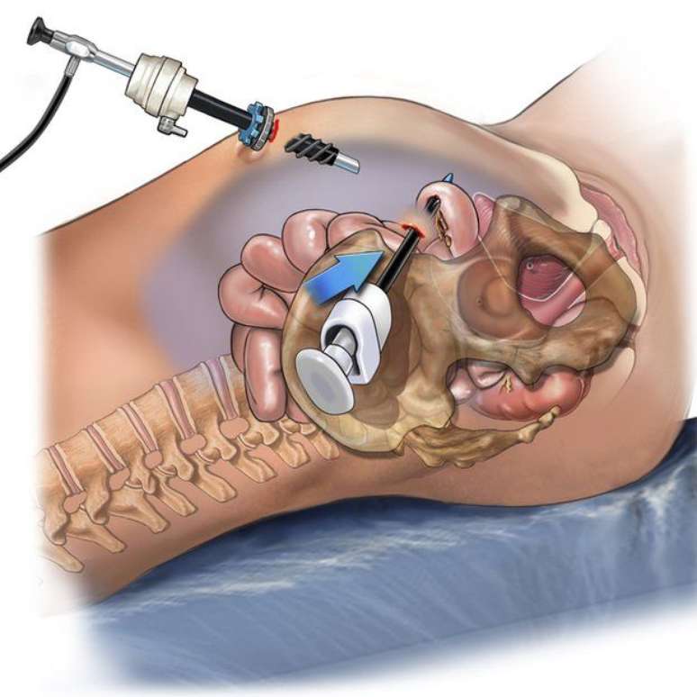 A laparoscopia é uma cirurgia pouco invasiva, em que são feitos pequenos cortes na parede abdominal para a introdução de câmeras, pinças e pequenos aparelhos para manipular os órgãos e vísceras.