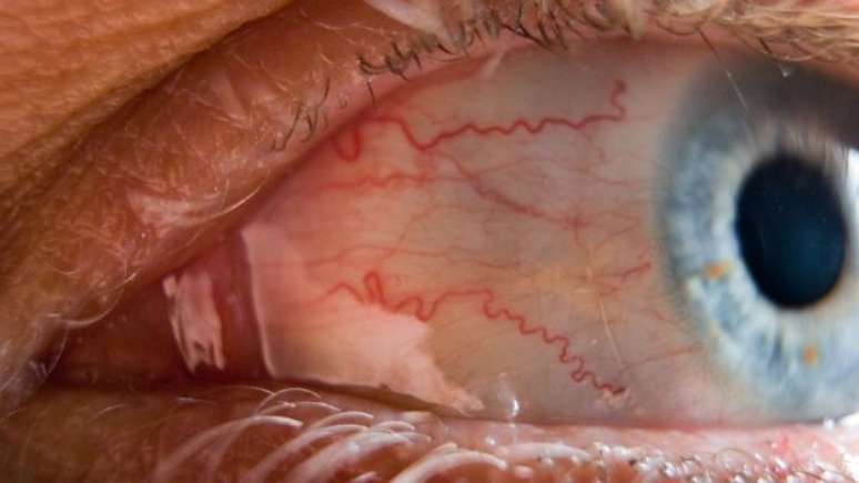Quando o cristalino se torna mais rígido ou os músculos do olho ficam mais fracos, começamos a ver as imagens desfocadas 