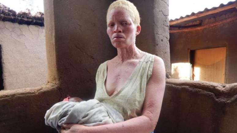 O albinismo é um distúrbio congênito caracterizado pela ausência de pigmento na pele, cabelos e olhos devido a uma deficiência na produção de melanina pelo organismo