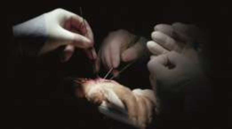 Cirurgia de reimplanta&ccedil;&atilde;o das m&atilde;os durou 27 horas