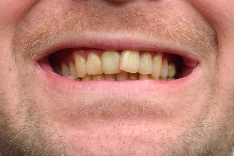 Os dentes caninos são sempre mais escuros que os restantes pois possuem maior quantidade de dentina.