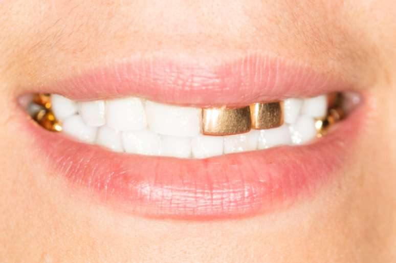 Antigamente, quando uma pessoa com restaurações feitas em ouro morria, a família pedia para que os dentes dourados fossem retirados. 