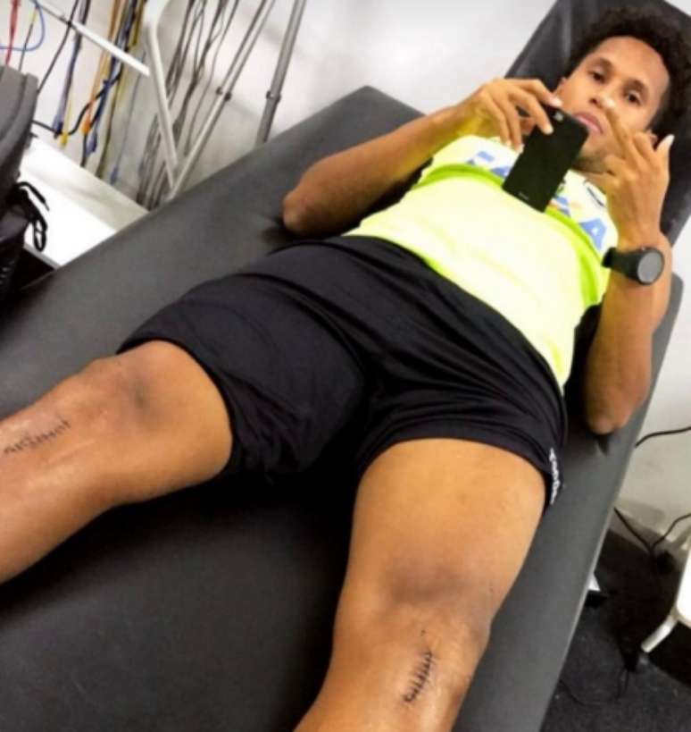 Jonas com a marca da operação realizada nos seu joelho esquerdo (Foto: Reprodução/Internet)