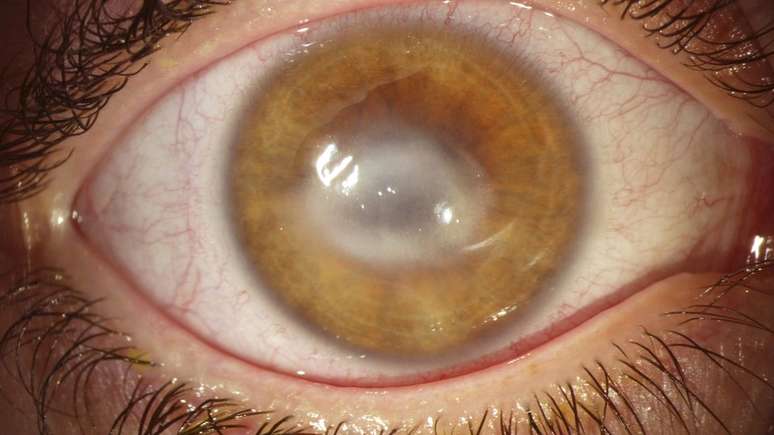 A ceratite amebiana &eacute; uma infec&ccedil;&atilde;o na c&oacute;rnea, a chamada "janela" na frente dos olhos