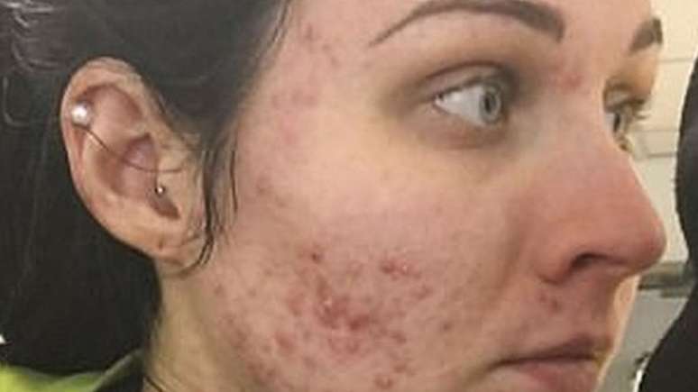 Judith postou uma foto no Instagram antes de começar o tratamento com um medicamento controlado contra acne severa