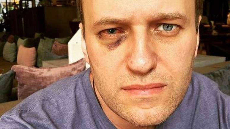 A imagem mostra como ficou o olho de Navalny após o ataque