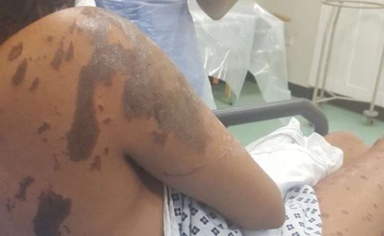 Resham teve queimaduras nos braços, pernas, rosto e ombros após o ataque 
