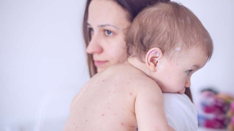 Crian&ccedil;a com sarampo