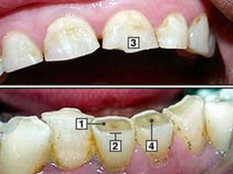 dentes com bruxismo