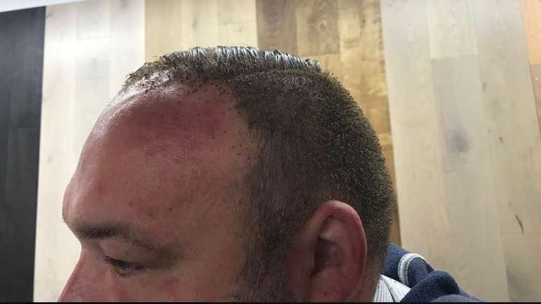 Peter Crowley teve a cabeça e o cabelo queimados com a explosão no metrô em Londres. Crédito: Facebook/Peter Crowley 
