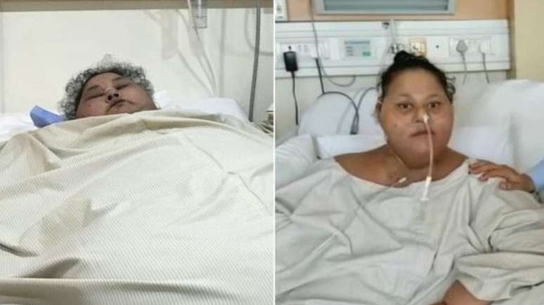 Antes e depois da cirurgia de Eman Ahmed Abd El Aty