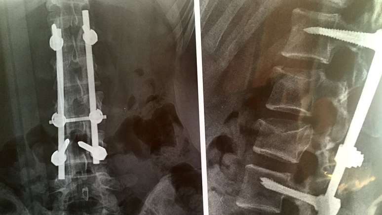 Raio-x da coluna vetebral de Maria With Hoen, mostrando implantes met&aacute;licos