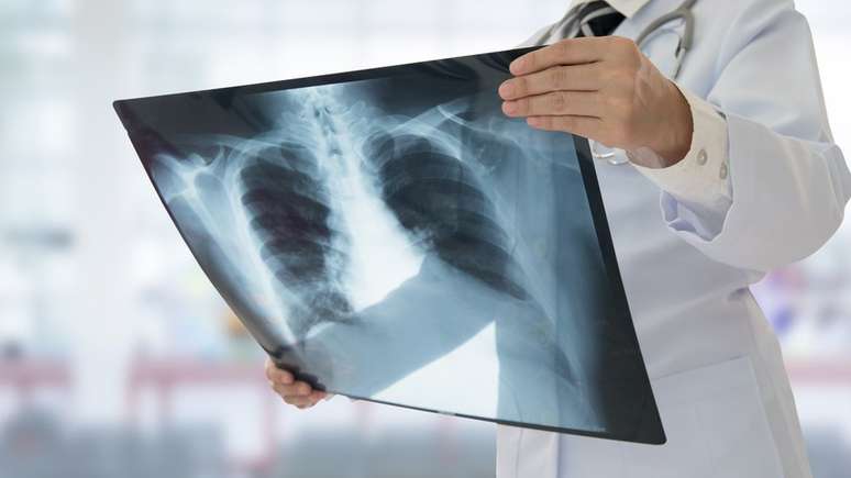 Raio-x de pulm&atilde;o