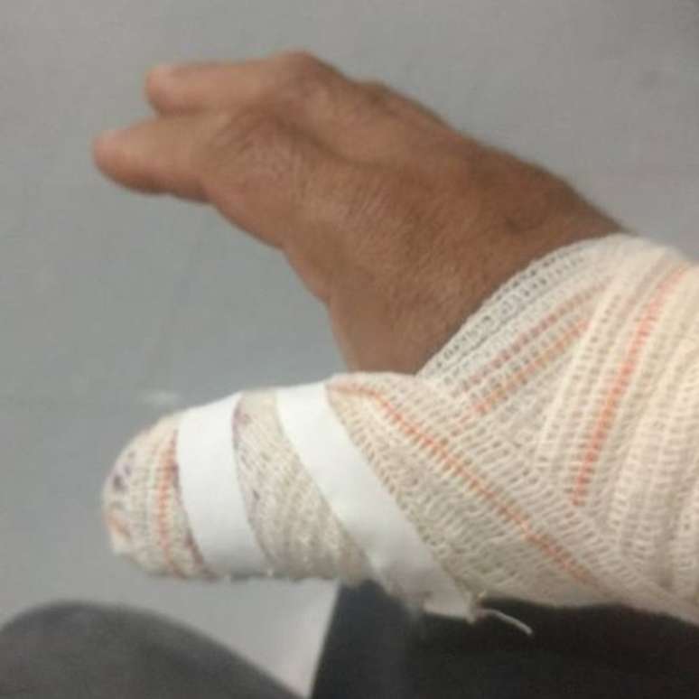 Durante briga, detento arrancou pedaço do dedo do carcereiro | Foto: Arquivo pessoal 