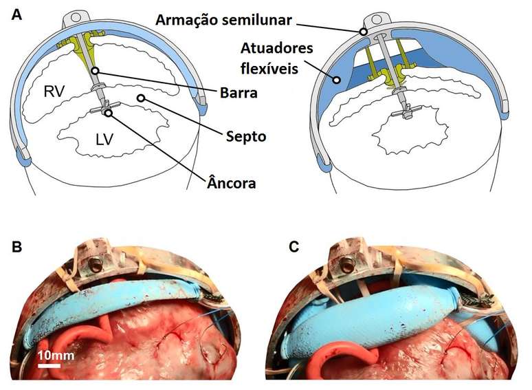 Detalhes do funcionamento do rob&ocirc; que auxilia a bombear sangue
