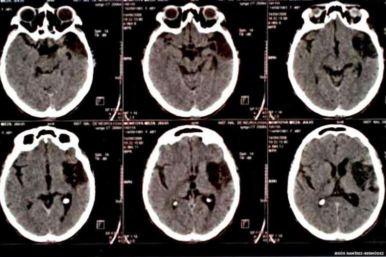 A Síndrome de Cotard pode estar ligada a danos no cérebro causados por traumas físicos (Foto: Jesus Bermudez-Ramirez)