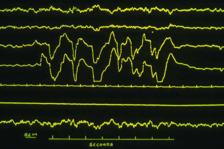Linhas erráticas mostram a REM, fase do sono na qual as pessoas sonham – parassonias acontecem em outra fase | Foto: Science Photo Library
