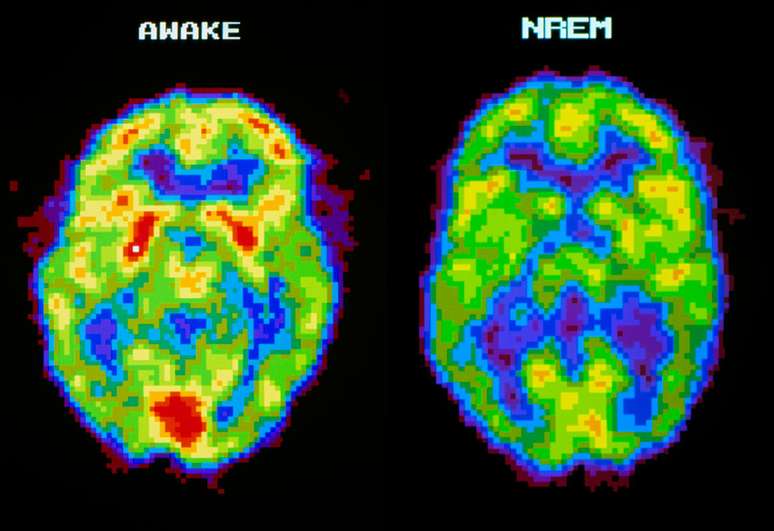 Um cérebro em sono profundo deve ser como a imagem da direita, mas partes do cérebro de um sonâmbulo se parecem com a da esquerda, de uma pessoa acordada | Foto: SPL