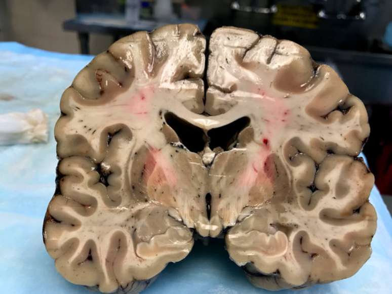 Apesar de aparência externa saudável, cérebro de Hernandez estava profundamente danificado por Encefalopatia Traumática Crônica | Foto: Boston University