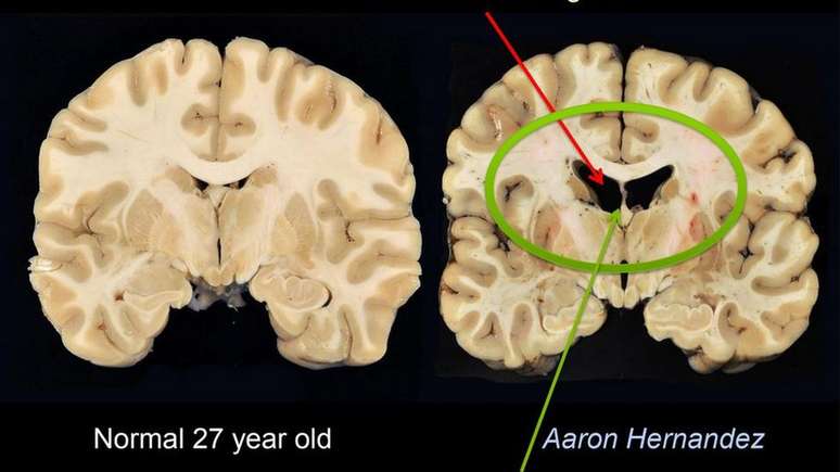Ao contrário do que seria normal em uma pessoa de 27 anos, cérebro de Hernandez tinha cavidades largas e tecido atrofiado | Foto: Boston University