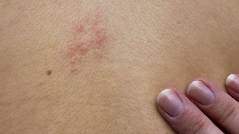 Doen&ccedil;a causada pelo v&iacute;rus da catapora pode ser ativada pelo estresse