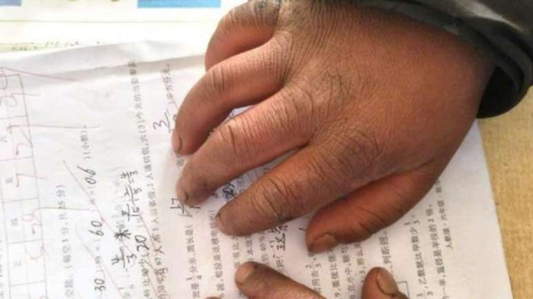 Foto mostra que Wang recebeu nota 99 em um teste, apesar das mãos sujas e inchadas | Foto: The Paper